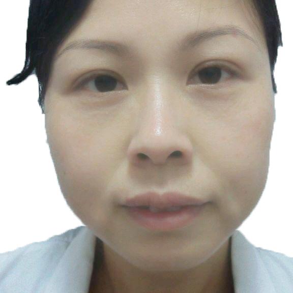 用冰敷和热敷,分别对眼睛有什么好处?